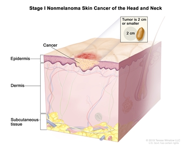 Stage I nonmelanoma skin cancer of the head and neck; drawing shows cancer in the epidermis. An inset shows that the tumor is 2 centimeters or smaller and that 2 centimeters is about the size of a peanut. Also shown are the dermis and the subcutaneous tissue below the dermis.