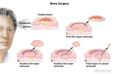 Mohs surgery; drawing shows a patient with skin cancer on the face. The pullout shows a block of skin with cancer in the epidermis (outer layer of the skin) and the dermis (inner layer of the skin). A visible lesion is shown on the skin's surface. Four numbered blocks show the removal of thin layers of the skin one at a time until all the cancer is removed.