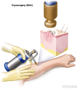 Cryosurgery; drawing shows an instrument with a nozzle held over an abnormal area on the lower arm of a patient. Inset shows a spray of liquid nitrogen or liquid carbon dioxide coming from the nozzle and covering the abnormal lesion. Freezing destroys the lesion.