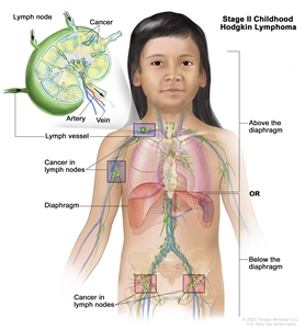 Stage II childhood Hodgkin lymphoma; drawing shows cancer in two lymph node groups above the diaphragm and below the diaphragm. An inset shows a lymph node with a lymph vessel, an artery, and a vein. Cancer cells are shown inside the lymph node.