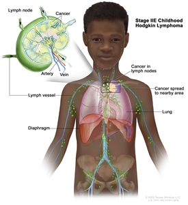 Stage IIE childhood Hodgkin lymphoma; drawing shows cancer in a lymph node group above the diaphragm and cancer that has spread to a nearby area (the left lung). An inset shows a lymph node with a lymph vessel, an artery, and a vein. Cancer cells are shown inside the lymph node.