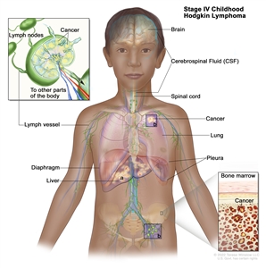 Stage IV childhood Hodgkin lymphoma; drawing shows cancer in the liver (a), the left lung (b), and in one lymph node group below the diaphragm (b). The brain, cerebrospinal fluid (shown in blue), spinal cord, and pleura are also shown. An inset on the left shows cancer cells inside a lymph node and cancer spreading through lymph nodes and lymph vessels to other parts of the body. An inset on the right shows cancer cells in the bone marrow.