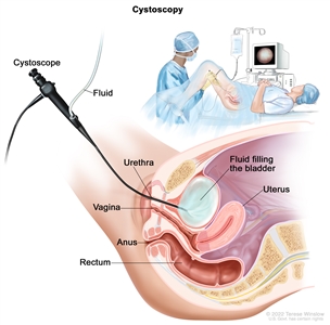 Cystoscopy; drawing shows a side view of the lower pelvis containing the bladder, uterus, and rectum. Also shown are the vagina and anus. The flexible tube of a cystoscope (a thin, tube-like instrument with a light and a lens for viewing) is shown passing through the urethra and into the bladder. Fluid is used to fill the bladder. An inset shows a woman lying on an examination table with her knees bent and legs apart. She is covered by a drape. The doctor looks at an image of the inner wall of the bladder on a computer monitor.