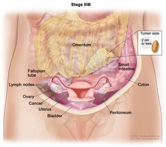 Drawing of stage IIIB shows cancer inside both ovaries that has spread to the omentum. The cancer in the omentum is 2 centimeters or smaller. An inset shows 2 centimeters is about the size of a peanut. Also shown are the small intestine, colon, fallopian tubes, uterus, bladder, and lymph nodes behind the peritoneum.