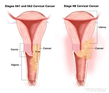 Stage II cervical cancer; drawing shows two cross-sections of the uterus, cervix, and vagina. The drawing on the left shows stages IIA1 and IIA2 cancer in the cervix that is 4 cm and has spread to the upper two-thirds of the vagina. The drawing on the right shows stage IIB cancer that has spread from the cervix to the tissue around the uterus.