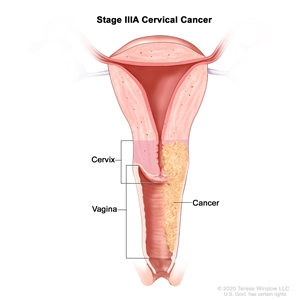 Stage IIIA cervical cancer; drawing shows a cross-section of the cervix and vagina. Cancer is shown in the cervix and in the full length of the vagina.