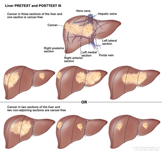 Liver PRETEXT and POSTTEXT III; drawing shows seven livers. Dotted lines divide each liver into four vertical sections that are about the same size. In the first liver, cancer is shown in three sections on the left. In the second liver, cancer is shown in the two sections on the left and in the section on the far right. In the third liver, cancer is shown in the section on the far left and in the two sections on the right. In the fourth liver, cancer is shown in three sections on the right. In the fifth liver, cancer is shown in the two middle sections. In the sixth liver, cancer is shown in the section on the far left and in the second section from the right. In the seventh liver, cancer is shown in the section on the far right and in the second section from the left.