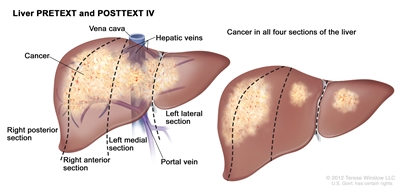 Liver PRETEXT and POSTTEXT IV; drawing shows two livers. Dotted lines divide each liver into four vertical sections that are about the same size. In the first liver, cancer is shown across all four sections. In the second liver, cancer is shown in the two sections on the left and spots of cancer are shown in the two sections on the right.