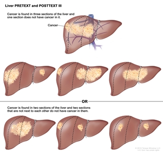 Liver PRETEXT and POSTTEXT III; drawing shows seven livers. Dotted lines divide each liver into four vertical sections that are about the same size. In the first liver, cancer is shown in three sections on the left. In the second liver, cancer is shown in the two sections on the left and the section on the far right. In the third liver, cancer is shown in the section on the far left and the two sections on the right. In the fourth liver, cancer is shown in three sections on the right. In the fifth liver, cancer is shown in the two middle sections. In the sixth liver, cancer is shown in the section on the far left and in the second section from the right. In the seventh liver, cancer is shown in the section on the far right and in the second section from the left.