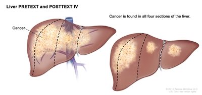 Liver PRETEXT and POSTTEXT IV; drawing shows two livers. Dotted lines divide each liver into four vertical sections that are about the same size. In the first liver, cancer is shown across all four sections. In the second liver, cancer is shown in the two sections on the left and spots of cancer are shown in the two sections on the right.
