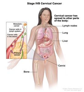 Stage IVB cervical cancer; drawing shows other parts of the body where cervical cancer may spread, including the lymph nodes, lung, liver, and bone. An inset shows cancer cells spreading from the cervix, through the blood and lymph system, to another part of the body where metastatic cancer has formed.