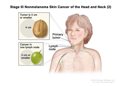 Stage III nonmelanoma skin cancer of the head and neck (2); drawing shows a primary tumor on the face and cancer in one lymph node on the same side of the body as the tumor. The top inset shows that the tumor is 4 centimeters or smaller and that 4 centimeters is about the size of a walnut. The bottom inset shows that the lymph node with cancer is 3 centimeters or smaller and that 3 centimeters is about the size of a grape.