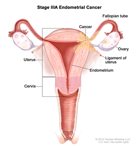 Stage IIIA endometrial cancer shown in a cross-section drawing of the uterus, ligaments of the uterus, cervix, fallopian tubes, ovaries, and vagina. Cancer is shown in the endometrium of the uterus, the outer layer of the uterus, a fallopian tube, an ovary, and a ligament of the uterus.