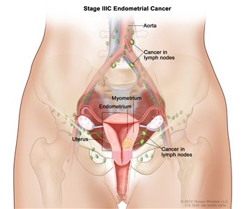 Stage IIIC endometrial cancer shown in a cross-section drawing of the uterus, cervix, fallopian tubes, ovaries, and vagina. Also shown are the lymph nodes in the pelvis and the aorta with nearby lymph nodes. Cancer is shown in the endometrium and myometrium of the uterus and in lymph nodes in the pelvis and near the aorta.