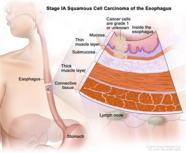 Stage IA squamous cell carcinoma of the esophagus; drawing shows the esophagus and stomach. An inset shows grade 1 cancer cells or cancer cells of an unknown grade in the mucosa layer and thin muscle layer of the esophagus wall. Also shown are the submucosa layer, thick muscle layer, and connective tissue layer of the esophagus wall. The lymph nodes are also shown.