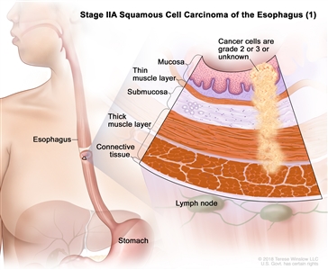 Stage IIA squamous cell carcinoma of the esophagus (1); drawing shows the esophagus and stomach. An inset shows grade 2 or 3 cancer cells or cancer cells of an unknown grade in the mucosa layer, thin muscle layer, submucosa layer, and thick muscle layer of the esophagus wall. Also shown are the connective tissue layer of the esophagus wall and the lymph nodes.