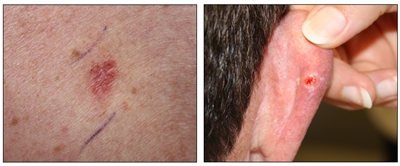 Photographs showing a skin cancer lesion that looks reddish brown and slightly raised (left panel) and the back of a person's ear with a skin cancer lesion that looks like an open sore with a pearly rim (right panel).