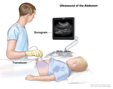 Abdominal ultrasound; drawing shows a child lying on an exam table during an abdominal ultrasound procedure. A technician is shown pressing a transducer (a device that makes sound waves that bounce off tissues inside the body) against the skin of the abdomen. A computer screen shows a sonogram (picture).