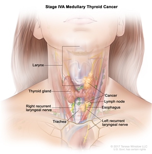 Stage IVA medullary thyroid cancer; drawing shows cancer in the thyroid gland and in the larynx, the esophagus, the left recurrent laryngeal nerve, the trachea, and a lymph node on one side of the neck. Also shown is the right recurrent laryngeal nerve.