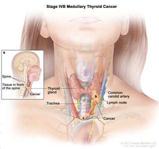 Stage IVB medullary thyroid cancer; drawing shows cancer has (a) spread from the thyroid gland to tissue in front of the spine and to the spine (inset), (b) surrounded the common carotid artery, and (c) surrounded the blood vessels in the area between the lungs. Also shown are the lymph nodes and trachea.