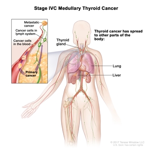Stage IVC medullary thyroid cancer; drawing shows other parts of the body where thyroid cancer may spread, including the lung and liver. An inset shows cancer cells spreading from the thyroid, through the blood and lymph system, to another part of the body where metastatic cancer has formed.