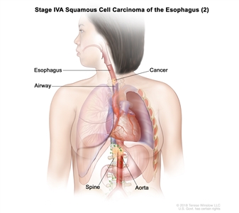 Stage IVA squamous cell carcinoma of the esophagus (2); drawing shows cancer in the esophagus, airway, aorta, and spine.