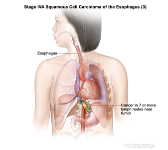 Stage IVA squamous cell carcinoma of the esophagus (3); drawing shows cancer in the esophagus and in 9 lymph nodes near the tumor.