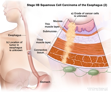 Stage IIB squamous cell carcinoma of the esophagus (2); drawing shows the esophagus and stomach. An inset shows (a) cancer cells of an unknown grade in the mucosa layer, thin muscle layer, submucosa layer, thick muscle layer, and connective tissue layer of the esophagus wall. Also shown is (b) the location of the tumor in the esophagus is unknown.