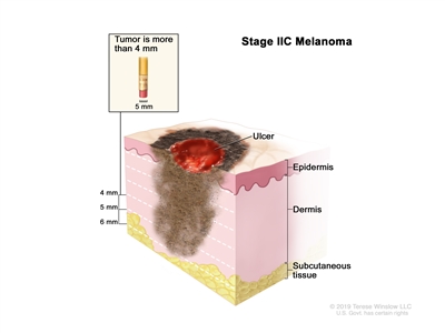Stage IIC melanoma; drawing shows a tumor that is more than 4 millimeters thick, with ulceration (a break in the skin). Also shown are the epidermis (outer layer of the skin), the dermis (inner layer of the skin), and the subcutaneous tissue below the dermis.