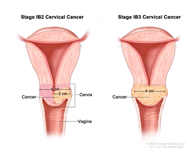 Stage IB2 and IB3 cervical cancer; drawing shows two cross-sections of the cervix and vagina. The drawing on the left shows stage IB2 cancer in the cervix that is larger than 2 cm but not larger than 4 cm. The drawing on the right shows stage IB3 cancer in the cervix that is larger than 4 cm.