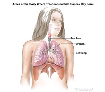 Drawing shows areas of the body where tracheobronchial tumors may form, including the trachea and the bronchi (large airways of the lung). The left lung is also shown.
