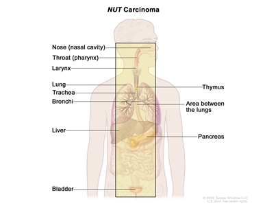 Drawing showing areas where midline tract carcinoma may form, including the nose (nasal cavity), throat (pharynx), larynx, lung, thymus, trachea, bronchi, area between the lungs, liver, pancreas, and bladder.