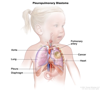 Drawing showing areas where pleuropulmonary blastoma may form, including the aorta, pulmonary artery, lung, heart, pleura, and diaphragm. Also shown is cancer in the left lung.