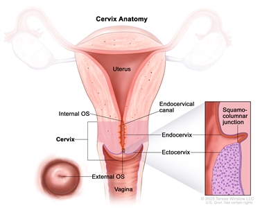 Anatomy of the cervix; drawing shows the internal OS, endocervical canal, endocervix, ectocervix, and external OS. A pullout shows the squamocolumnar junction (the area where the endocervix and ectocervix meet) and the cells that line the endocervix and ectocervix. The uterus and vagina are also shown.
