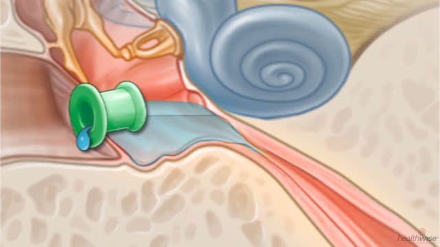 Tubes for Ear Infections