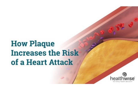 How Plaque Increases the Risk of a Heart Attack