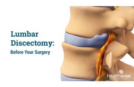 Lumbar Discectomy: Before Your Surgery