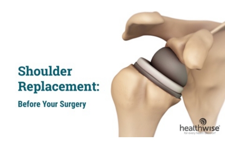 Shoulder Replacement: Before Your Surgery