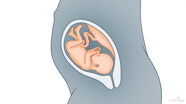 Pregnancy: Signs of Preterm Labor