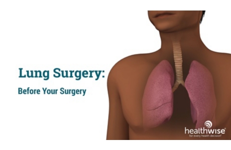 Lung Surgery: Before Your Surgery