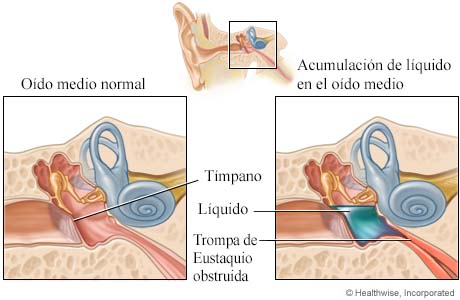 Oído medio normal y acumulación de líquido en el oído medio