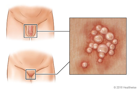 Ubicación del herpes genital, con primer plano de las ampollas