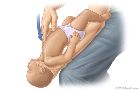 Imagen D: Posición del bebé sobre el muslo para la maniobra de Heimlich; se muestran la posición y la dirección de las compresiones en el pecho