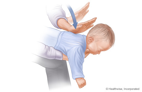 Imagen C: Posición del bebé sobre el brazo para la maniobra de Heimlich; se muestran la posición y la dirección de las palmadas en la espalda