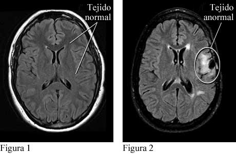 Imágenes de tejido cerebral normal y tejido cerebral anormal que causa convulsiones