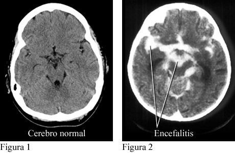 Tomografías computarizadas de un cerebro normal y de un cerebro con encefalitis