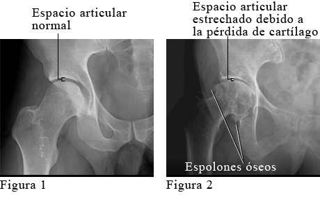 Radiografía de osteoartritis de la cadera