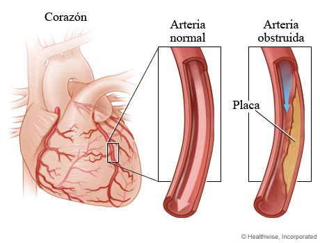 Arteria coronaria normal y arteria que se ha estrechado por la placa