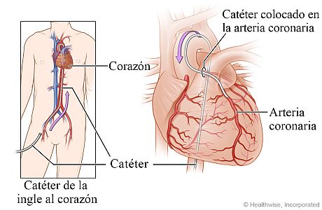 Catéter que va desde la ingle al corazón, con detalle del catéter en una arteria coronaria