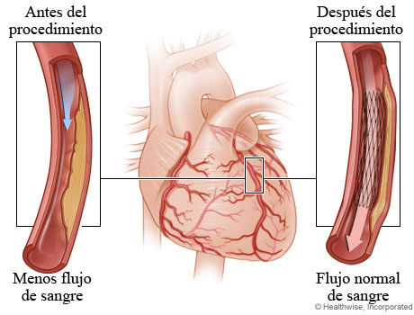 Disminución del flujo de sangre debido al estrechamiento de la arteria antes de la angioplastia en comparación con flujo sanguíneo normal después de la angioplastia
